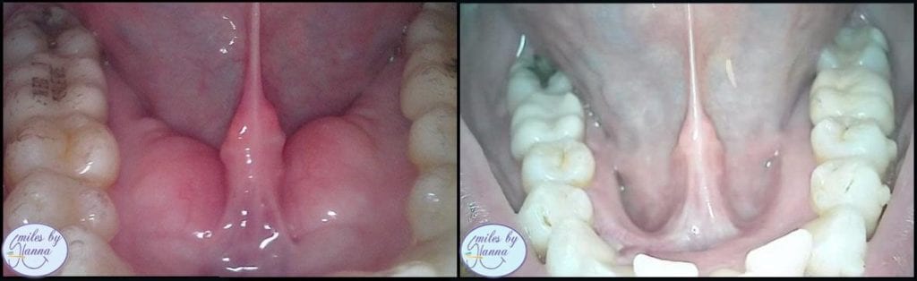 Tori Dental Removal – Does it Hurt?