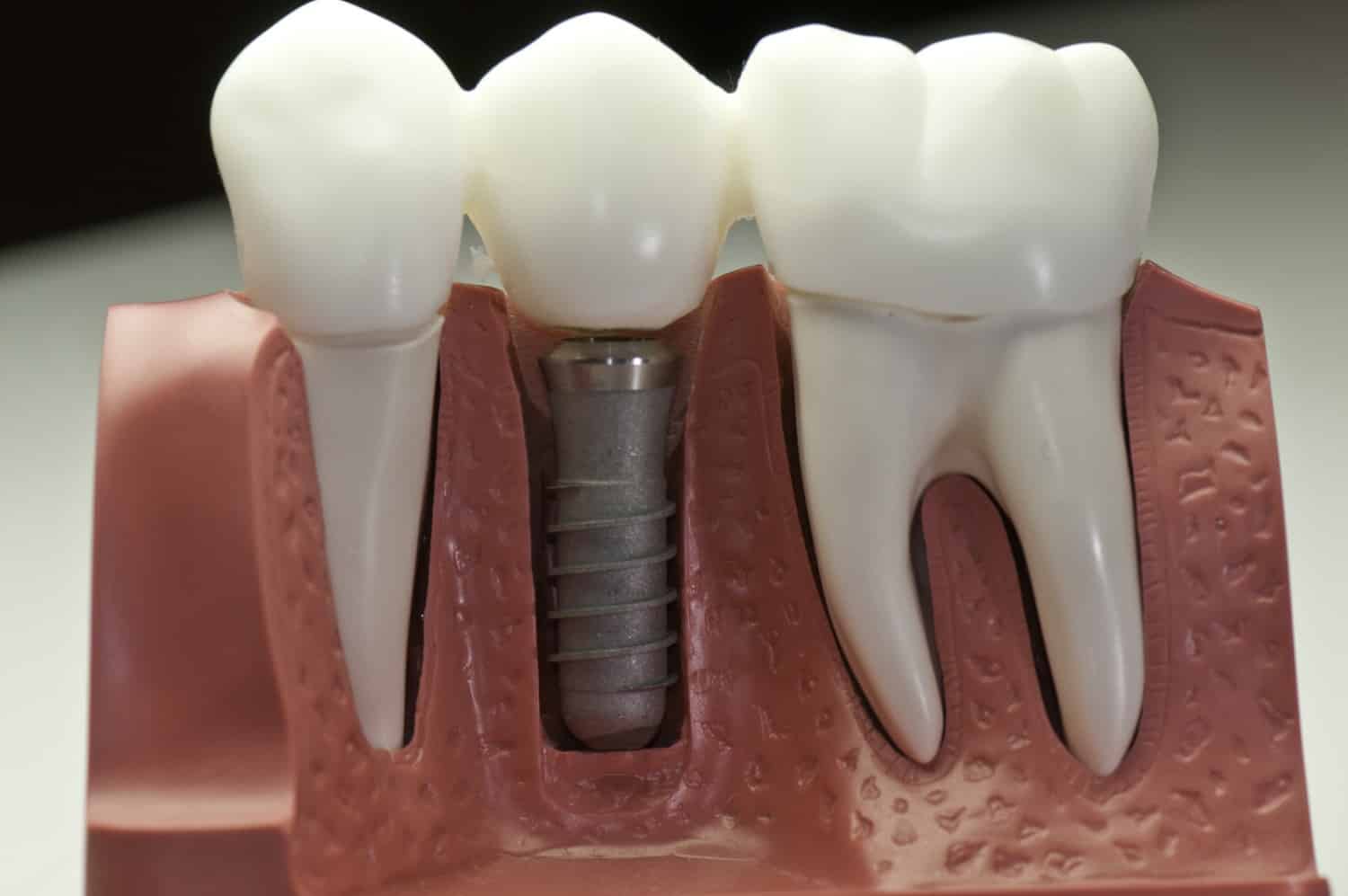 can dental implants get cavities