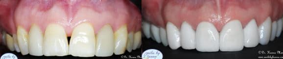 Dental Veneers Before and After - Photo #2