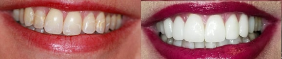 Dental Veneers Before and After - Photo #1