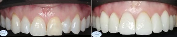 Dental Veneers Before and After - Photo #3