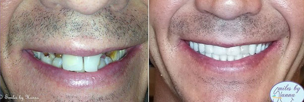 Dental Implants Before and After - Photo #2