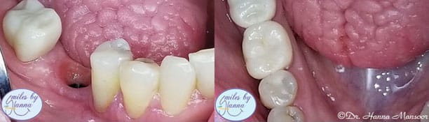 Dental Implants Before and After - Photo #3