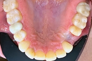Dental Implants Step 1