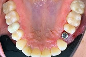 Dental Implants Step 2
