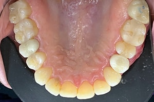 Dental Implants Step 3