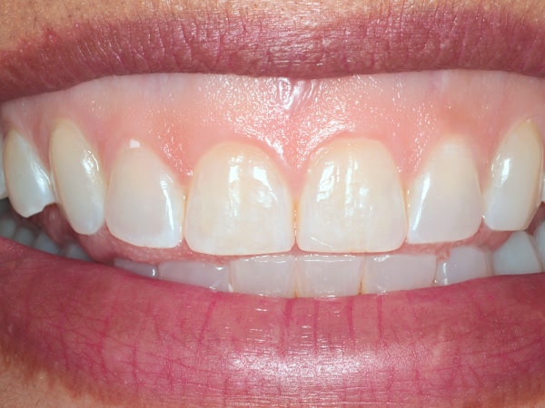 What You Need To Know About Gummy Smile Treatment With Lasers