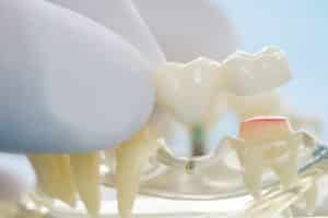 dental tooth bridge model 