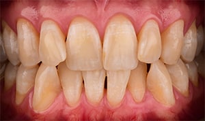 Teeth Whitening Step 1