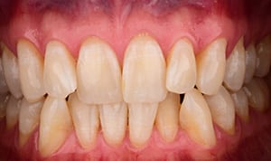 Teeth Whitening Step 2