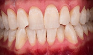 Teeth Whitening Step 3