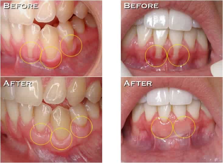 before and after a gum graft
