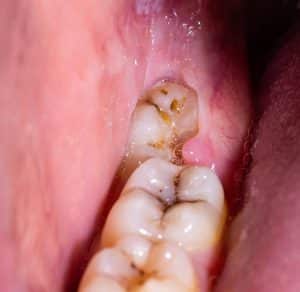 an impacted wisdom tooth inside of someone's mouth