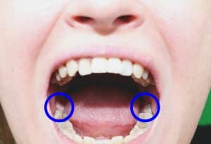 picture of a patient with their mouth open showing their wisdom teeth prior to removal