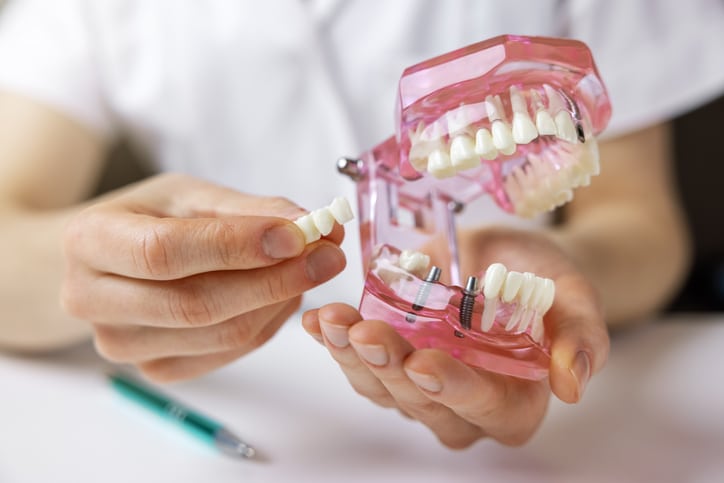 Everything You Never Knew About Dental Bridges