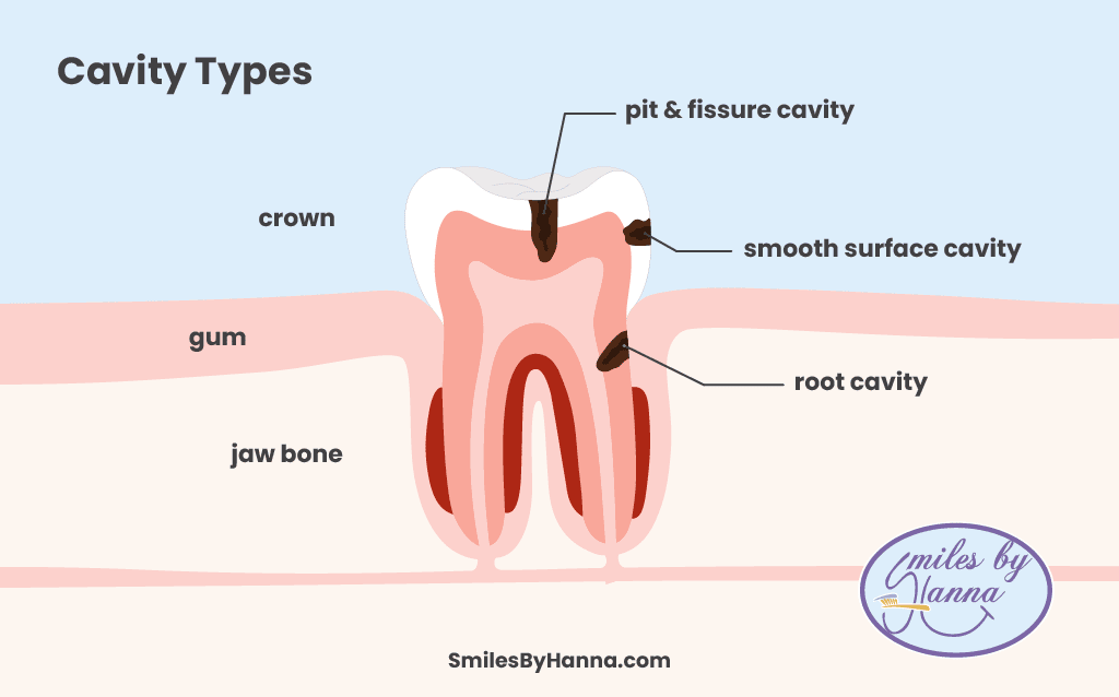 How a Cavity is Formed