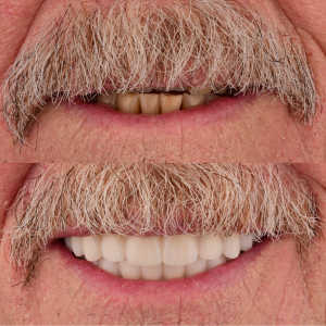All on 6 Dental Implants before and after