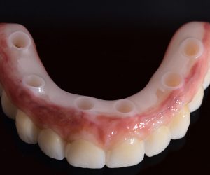 Dental Implant material