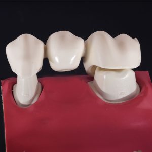 Dental Bridge Model