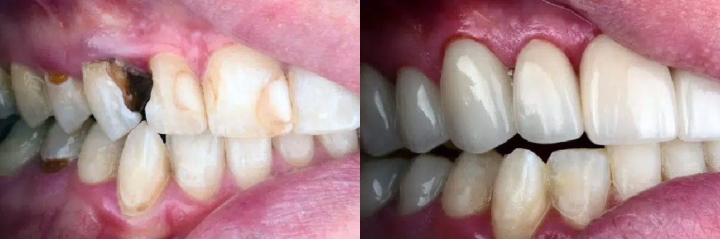 before and after replacing multiple teeth