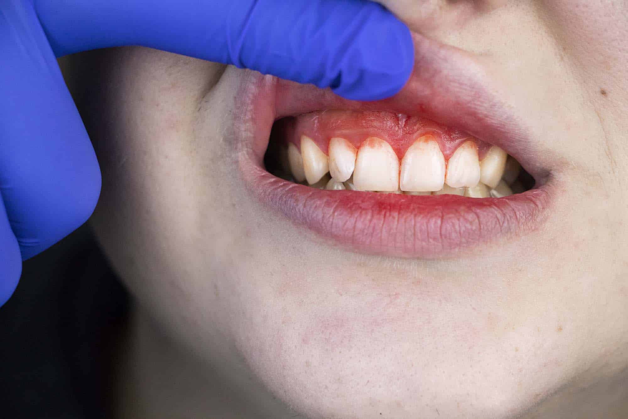 Bleeding and Gum Disease