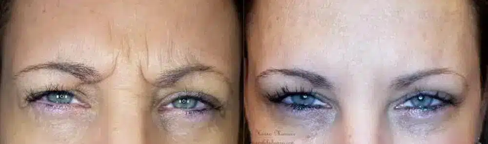 Botox Injections Around the Eyes