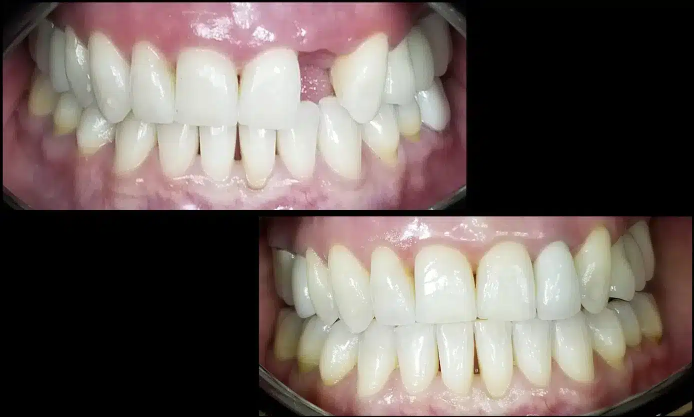 Dental Bridge Before & After