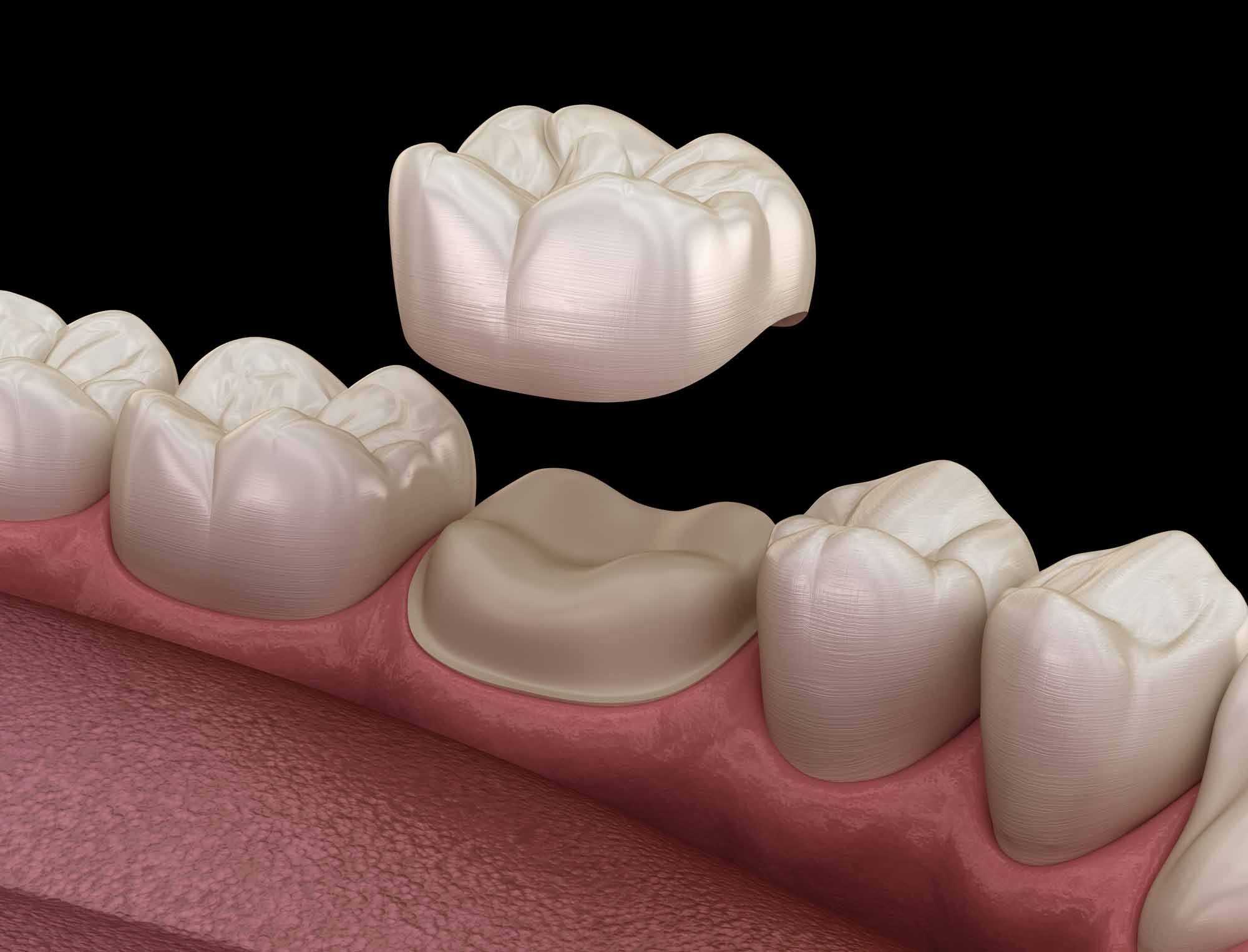 Example of a Dental Crown