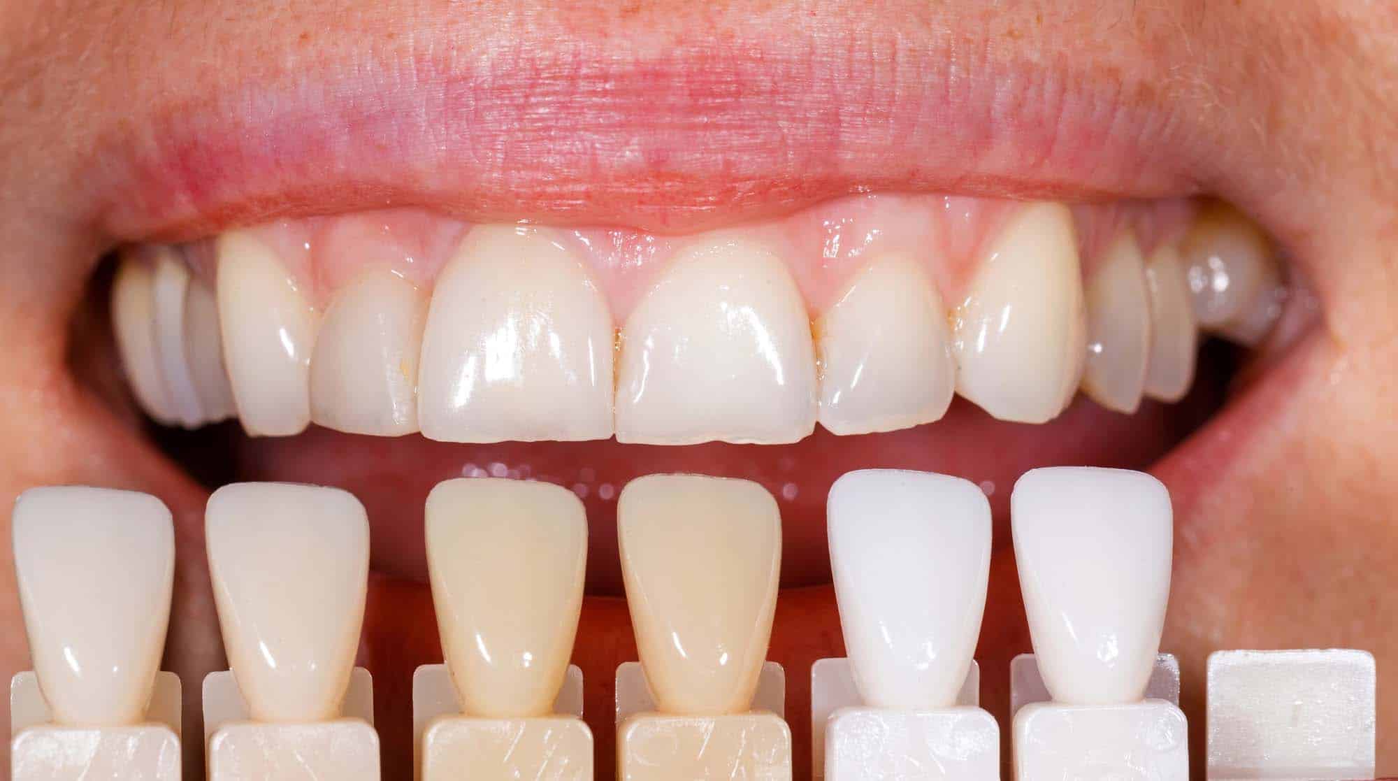 Shades of Dental Veneers