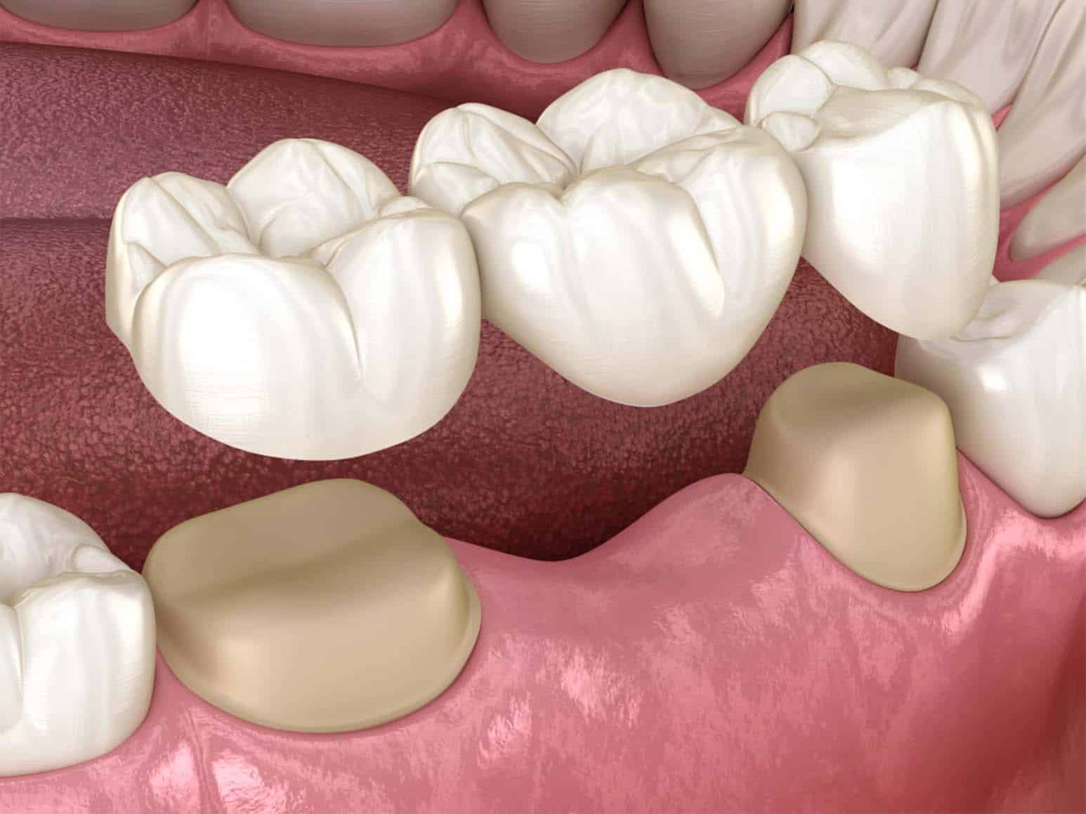 Tooth Crowns Example