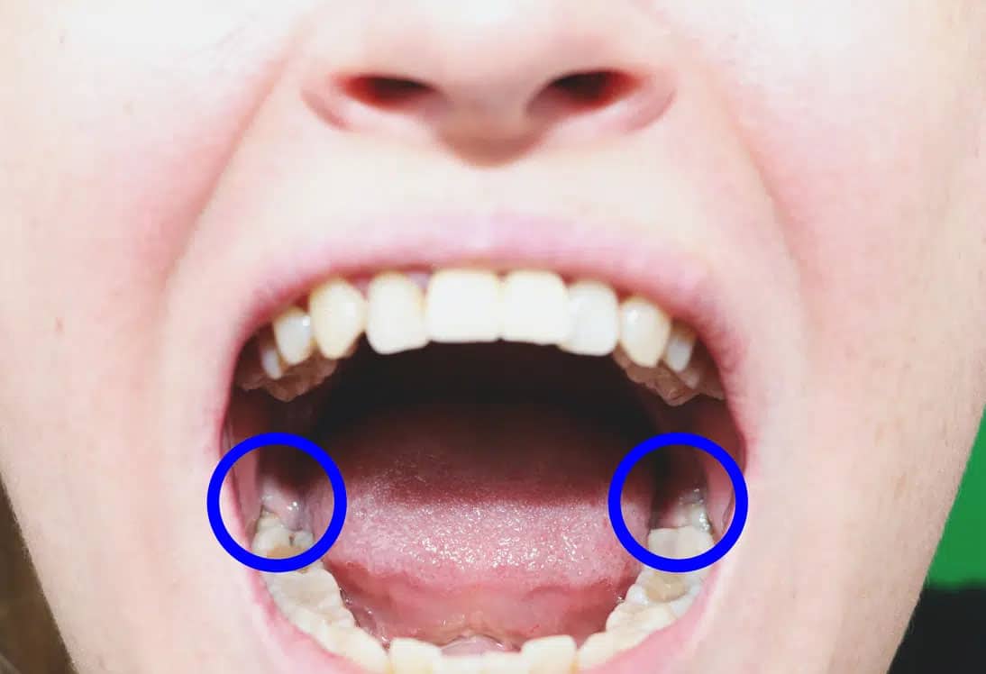 Wisdom Teeth Example In Mouth
